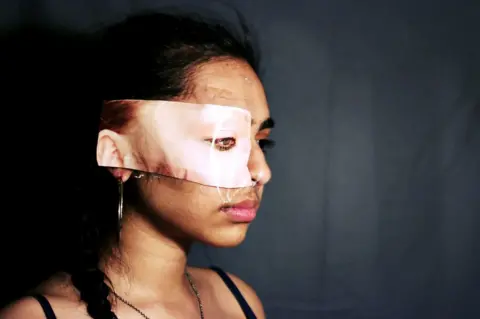 Maddy Turner A girl has white skin taped over her eye